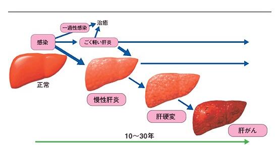 深圳肝炎治療的五大禁忌 深圳肝炎治療的五大禁忌